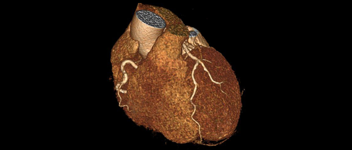 一項硬科技，讓CTA冠脈診斷方式徹底顛覆